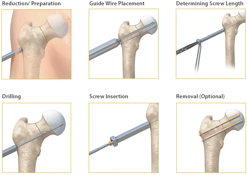 Cannulated Cancellous Screws Surgical Technique
