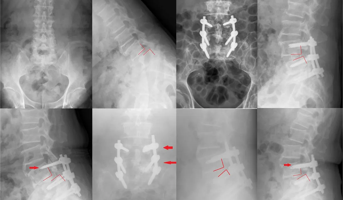 Cannulated Pedicle Screw Uses