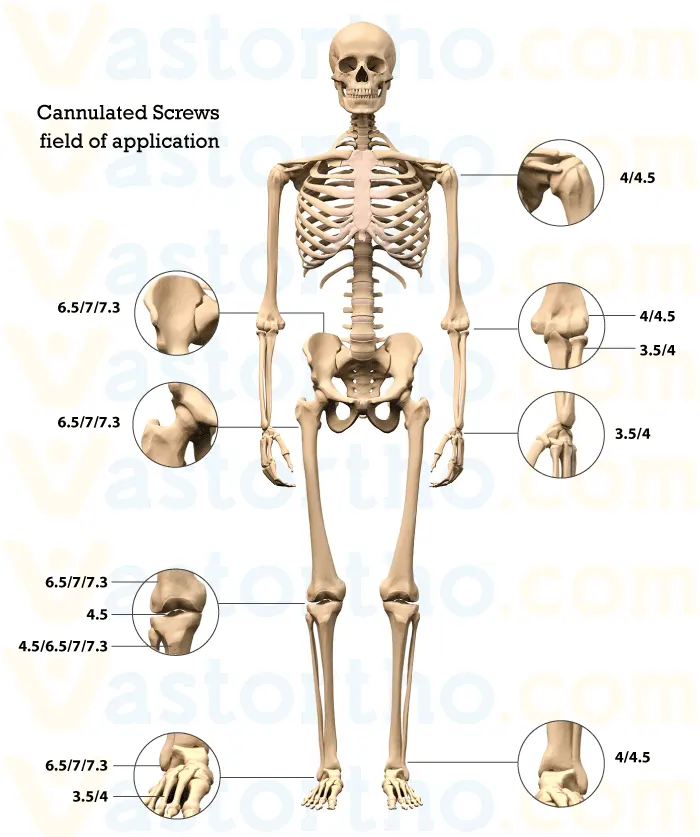 Cannulated Screws Fields of Application