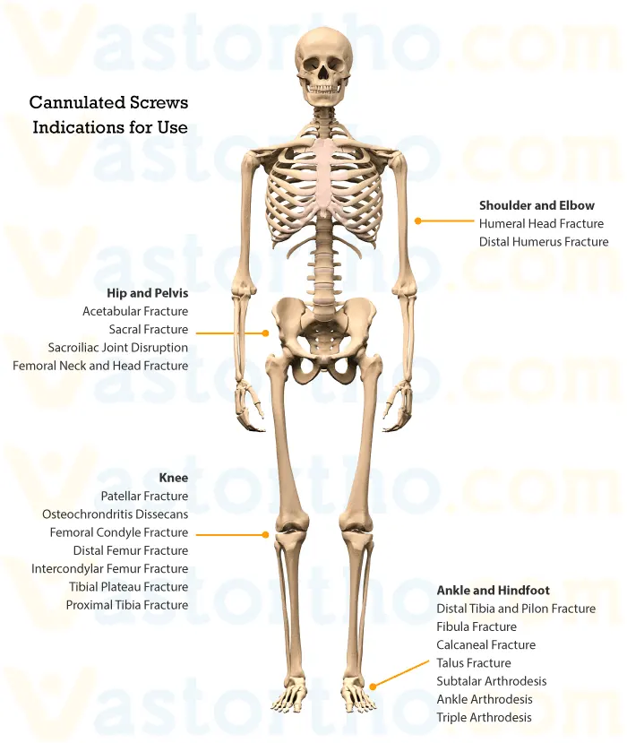 Cannulated Screws Indications for Use