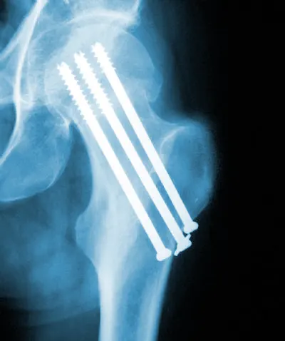 Cannulated screws Uses