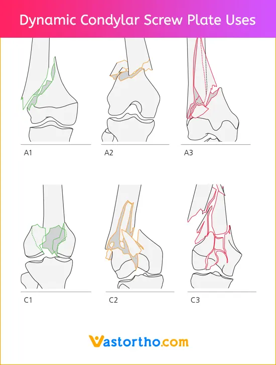 Dynamic Condylar Screw Plate Uses