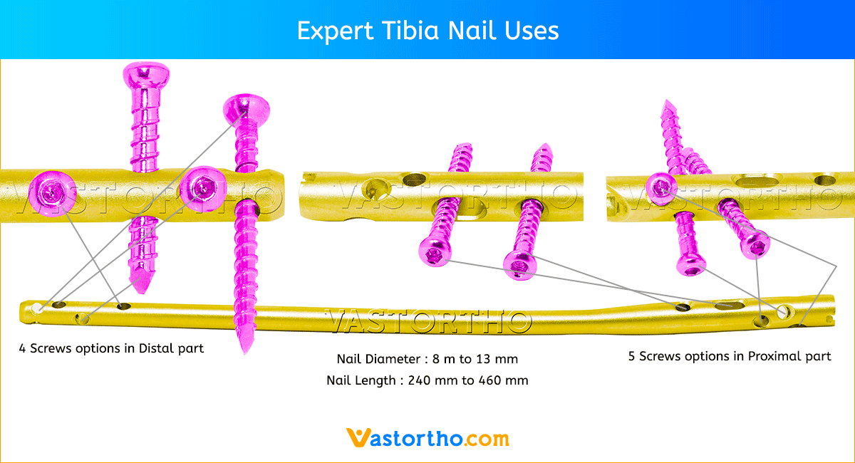 Expert Tibia Nail Uses