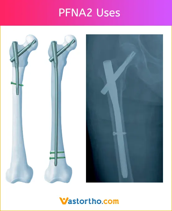 PFNA2 Uses