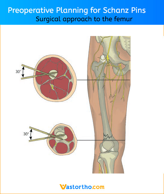 Preoperative Planning for Schanz Pins Femur