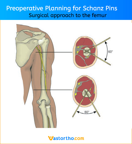 Schanz Pin Uses, Sizes & Surgical Techniques • Vast Ortho