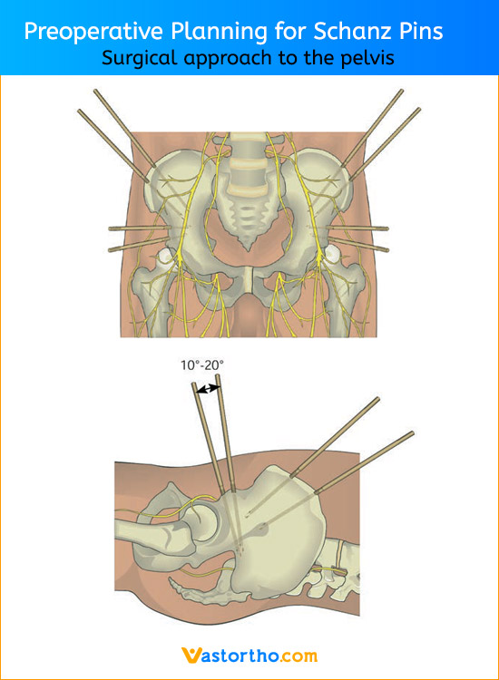 Preoperative Planning for Schanz Pins Plevis