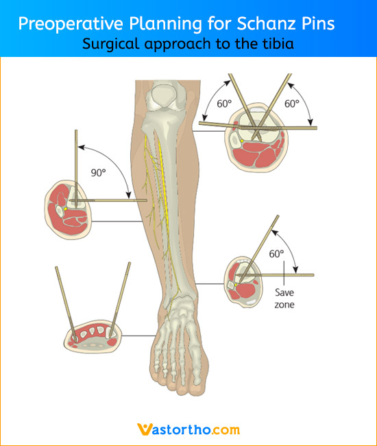 Schanz Pin Uses, Sizes & Surgical Techniques • Vast Ortho