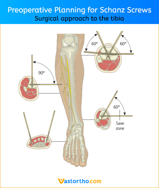 Schanz Screw Uses, Sizes & Surgical Techniques • Vast Ortho