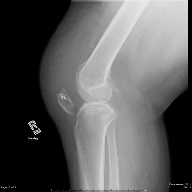 Suture Anchors screws Uses, Sizes & Surgical • Vast Ortho