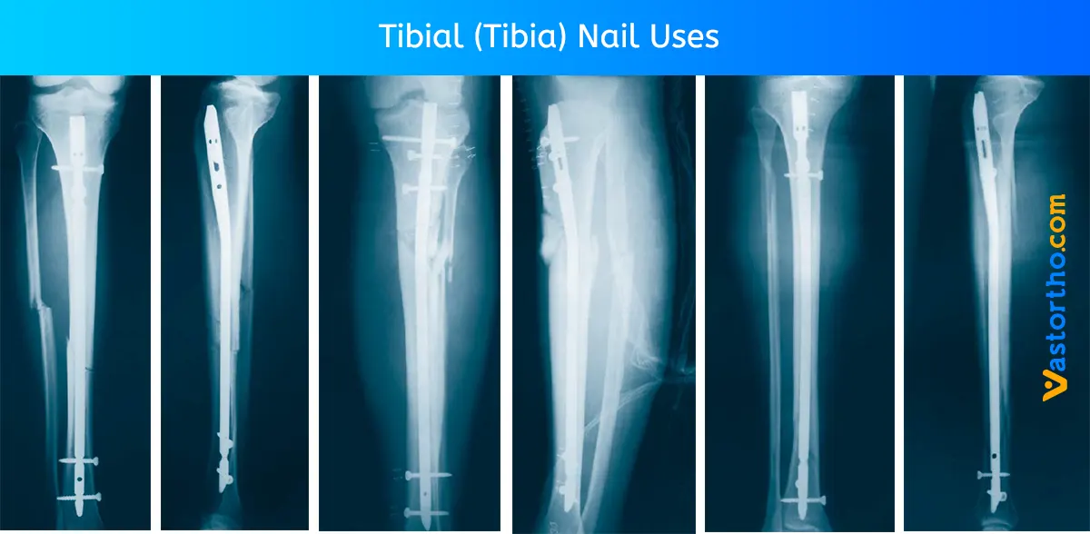 Expert-Tibial-Nail-Titanium-System-10-Unit-With-1-Unit-End-Cap-and-9-Unit-Screws  | eBay