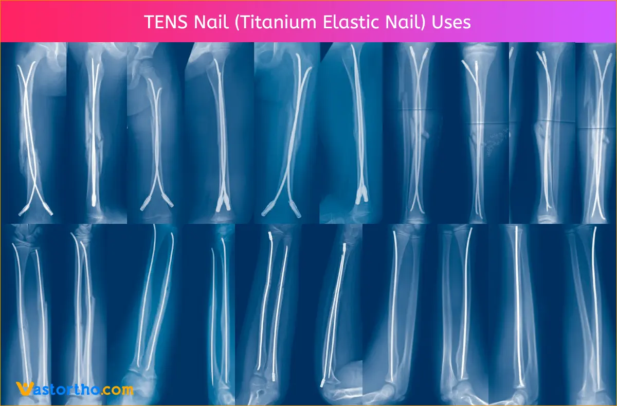 Titanium Elastic Nail Instruments Set Uses